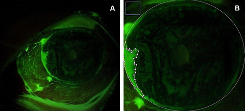 Figure 1 Picture of the fluorescein stained-positive epithelial defect after pterygium excision (A) original picture (B) area of manual delineation using imageJ to analyze the fluorescein stained-positive epithelial defect.