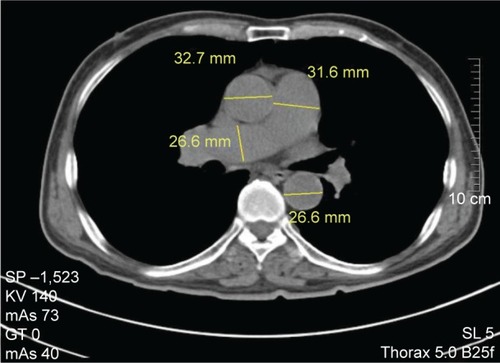 Figure 1 Measurement of main pulmonary artery (MPA), right pulmonary artery (RPA), ascending aorta (AAo), and descending aorta (DAo) diameters at the level of the pulmonary artery bifurcation.Note: MPA diameter =31.6 mm, RPA diameter =26.6 mm, AAo diameter =32.7 mm, and DAo diameter =26.6 mm.