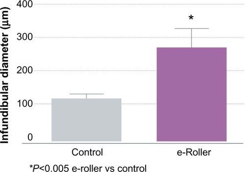 Figure 3 Graphical representation of the average diameter of the infundibulum the massaged skin (gray bar) and the e-roller treated skin (purple bar).