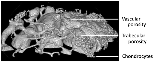 Figure 3. Porosity in continuity with trabecular porosity on top condyle.