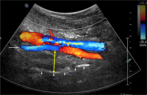 Figure 1 USG-measured LPW thickness (indicated by the yellow double-headed arrow) in between the internal carotid artery (indicated by the long arrow) and the lateral wall of the pharynx (indicated by the arrowheads).