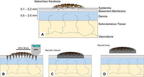 Figure 2 Dynamics in removal of seborrheic keratosis by high-frequency HIFU. (A) An epidermal seborrheic keratosis (SK) is located in the skin. (B) Shoulder-by-shoulder HIFU doses are placed to cover the SK-field including a small margin. (C) A necrotic volume containing SK cells is formed directly after treatment. (D) The wound crust is spontaneously released after 1–2 weeks after damaged cells have been replaced.