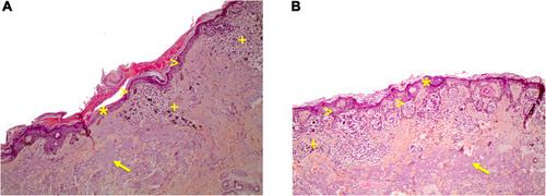 Figure 5 (A) Histological pictures of lentigo maligna. Lentigo maligna in the radial growth phase. Solar elastosis (arrow), a patchy lymphocytic infiltrate and melanophages are seen in the dermis (+ sign). An atrophic epidermis (asterisk) and an increased density of melanocytes along the dermal-epidermal junction can be seen, some of them with variable nuclear atypia (arrowheads). Hematoxylin-eosin stain10x. (B) Extrafacial lentigo maligna on chronically sun-damaged skin. Atrophic epidermis (asterisk), prominent solar elastosis (arrow) and increased density of junctional pleomorphic melanocytes forming asymmetric nests with pagetoid growth of single melanocytes (arrowheads). Dermal inflammatory infiltrate with melanophages (+ sign). Hematoxylin-eosin stain10x.
