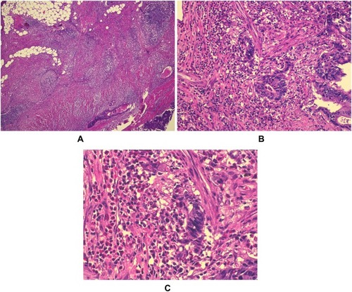 Figure 1 Peritumorous inflammation in a colorectal carcinoma. (A): Crohn’s like lymphoid reaction (CLR), hematoxylin-eosin (HE) staining, original magnification (OM) 40×; (B): inflammation in invasion site, HE, OM 100×; (C): mixed cellular composition in peritumorous tissue, HE, OM 400x.