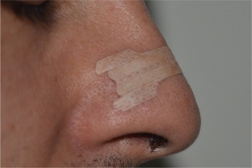 Figure 2 Side view of the external nasal dilator application site.