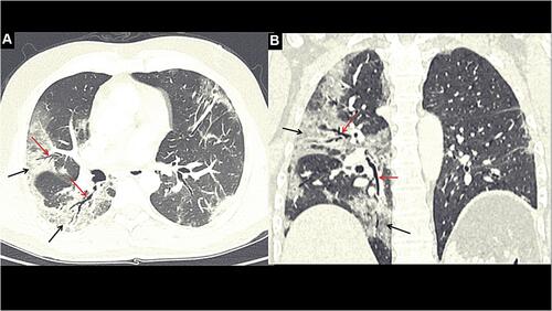 Figure 3 A 48-year-old male who was hospitalized for COVID-19 pneumonia, presents with persistent dyspnea and fatigue after 8 weeks of discharge. High resolution computed tomography (HRCT) chest, axial (A) and coronal (B) reformatted images, showing bilateral peripheral areas of ground glass opacity (GGO) (black arrows) and interstitial thickening (right > left) with traction bronchiectasis (red arrows) in right middle and lower lobe.