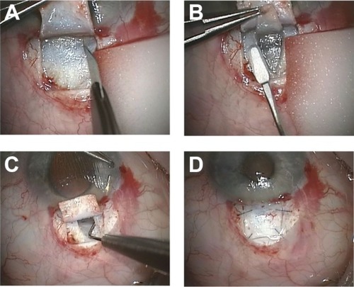 Figure 1 Surgical technique of modified filtering trabeculotomy.