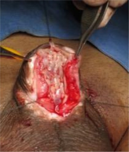 Figure 11 Dorsal inlay augmentation in a contracted graft.