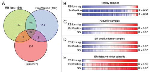 Figure 2 Correlation between the RB target signature and signatures representing cell proliferation and histological tumor grade. (A) A Venn diagram representing overlap between the RB target signature, the proliferation signature and GGI signature. (B–E) The expression of RB-loss, proliferation and GGI signatures is highly correlated.