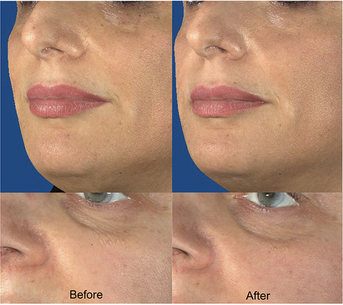 Figure 5 Photographs of selected participants before and after 4 weeks of treatment with a KP1 face serum. Courtesy of DERMING, S.r.l.