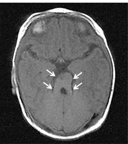 Figure 1 Case 1: cranial MRI showing “molar tooth sign” (arrows), which is a classic finding in Joubert syndrome.