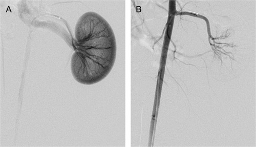 Figure 13 Arterial angiogram of a rabbit’s left kidney, before embolization (A) and immediately after embolization (B).Note: The peripheral blood vessels were occluded with FNMs (100–300 μm) after embolization.Abbreviation: FNMs, magnetic polymer microspheres.