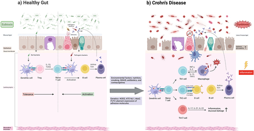 Figure 3. Schematic illustration of the interaction between the host microbiome, the intestinal barrier, and pathological agents under healthy conditions and in active CD. Anti-inflammatory cytokines (IL-10, TGF-β) are released via activation of regulatory T cells (Tregs), so that no activation of CD4+ T cells occurs. This mediates tolerance to symbiotic microorganisms. After pathogen invasion of the intestine, CD4+ T cells are activated by dendritic cells, and then B cells are activated by Th2 cells, which differentiate into antibody-producing plasma cells. In addition to activation of the acquired immune system, defense processes of the innate immune system also take place, e.g., by defensins. (A) dysbiosis promoted by genetic predisposition and/or environmental factors leads to an excessive proinflammatory immune response and increased permeability of the intestinal barrier. Differentiation into Th1, Th2 and Th17 cells occurs via activation of CD4+ T cells. The Th1 cell activates macrophages via cytokines, which produce reactive oxygen species (ROS) in addition to their phagocytotic function. Macrophages also maintain the Th1 response with the help of cytokines. The Th2 cells activate B cells to differentiate into antibody-producing plasma cells. The Th17 cell dominates alongside the Th1 cell in CD and promotes the inflammatory process and destruction of the mucosal barrier in the intestine via cytokines. Due to the genetic changes, there is insufficient defensin production, so that the innate immune defense is significantly impaired in its function. The ongoing inflammation promotes the aggravation of dysbiosis as part of an endless spiral (B).