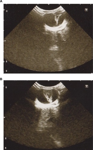 Figure 1 Ocular B-scan ultrasonography (transverse section) at 2 days of age showing funnel retinal detachment of right eye (A) and left eye (B).