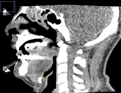 Figure 1 The epiglottic length (from the free edge to the base of the epiglottis) and the epiglottic angle (the angle between the long axis of the epiglottis and the vertical plane) are measured using ImageJ software.