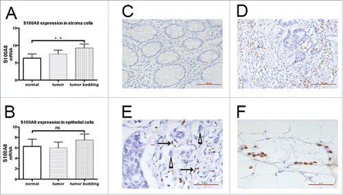 Figure 1. Distribution of S100A8+ cells in CRC tissues. A, S100A8 expression in stroma cells surrounding normal epithelial cells (p = 0.042) and tumor cells (p = 0.0048) was lower than in those surrounding tumor budding cells. B, S100A8 expression did not differ among normal epithelia, tumor cells, and tumor budding cells. C, S100A8+ cells in normal epithelial stroma (20×), scale bar: 100μm. D, S100A8+ cells (brown) in the tumor invasive front (20×), scale bar: 100μm; E, S100A8+ cells (arrow) distributed around tumor budding (triangle) (40×), scale bar: 50μm; tumor buddings are defined as comprising five tumor cells or less, appearing at the invasive front of a subset of colorectal adenocarcinomas of tiny cords of neoplastic epithelium that extend from the neoplastic glands into the adjacent stroma, and small aggregates of neoplastic epithelium that appear to have detached and migrated a short distance into a usually quite desmoplastic stroma; Patients parameters: TNM III, lymphonde metastasis, metastasis and vessel infiltration positive. F, S100A8+ cell-marginated vessels (40×), scale bar: 50μm; Patients parameters: TNM II, lymphonde metastasis, metastasis and vessel infiltration negative.