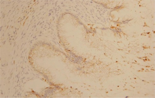 Figure 5 Cytokeratin 7 focally positive staining (×10).