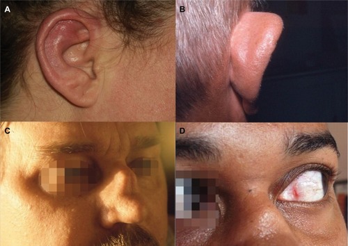 Figure 1 Relapsing polychondritis: auricular chondritis during acute phase (A); chronic phase with collapse of the cartilage of the upper pole of the ear (B); saddle nose deformity (C); episcleritis (D).