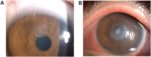 Figure 1 Slit-lamp examination revealed that the cornea of the right eye (A) was transparent, the upper corneal epithelium was poorly healed, and the anterior chamber was normal. (B) In the left eye, mixed congestion of the bulbar conjunctiva, corneal edema, and white infiltrating foci with crab-like changes with unclear boundaries of approximately 2×3mm2 in the center, unclear lesion boundaries with annular reaction ring, corneal endodermis and Descemet’s folds radially perpendicular to the lesion, and sediments adhering to endodermis were observed.