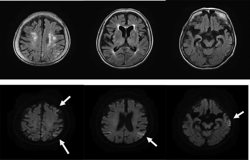 Figure 2. a. Magnetic resonance imaging (MRI) findings obtained using fluid-attenuated inversion-recovery (FLAIR) (upper) and diffusion-weighted images (DWI) (lower) in an 89-year-old woman. DWI shows cortical hyperintensities in some areas of both hemispheres; the white arrows indicate areas of cortical hyperintensity in the left hemisphere.