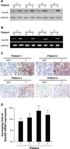 Figure 2 Overexpression of Sam68 in primary neuroblastoma tissues.