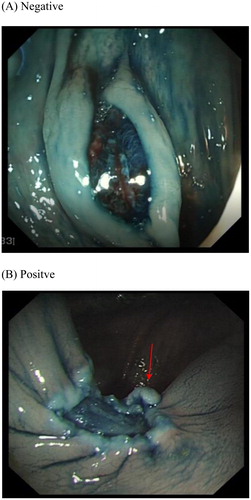 Figure 2. (A) Negative and (B) Positive post snare polypectomy margin and base as viewed following application of 0.13% Indigo Carmine.