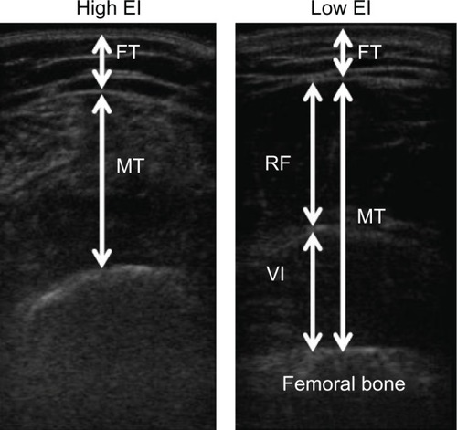 Figure 1 Typical examples of the high (left) and low (right) echo intensity of the rectus femoris muscle.Note: The value of EI, defined as the mean pixel intensity in the muscle, was determined by gray scale analysis.Abbreviations: EI, echo intensity; FT, subcutaneous fat thickness; MT, muscle thickness; RF, rectus femoris muscle; VI, vastus intermedius muscle.