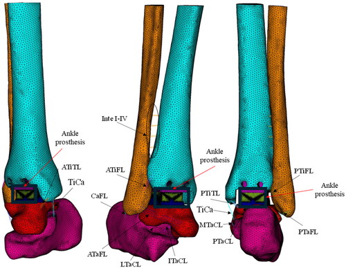 Figure 2. FE model of implanted ankle joint shows different ligamental boundary conditions.