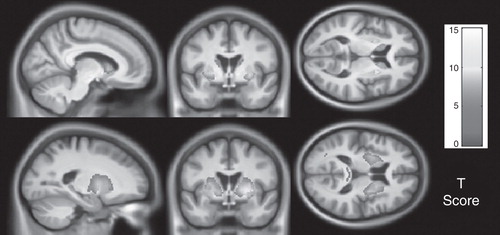 Figure 1. Parametric maps showing regions with statistically significant atrophy over 24 months in grey (top) and white matter (bottom) in far-from-onset premanifest subjects compared with controls. Results were adjusted for age, sex, study site and scan interval and are corrected for multiple comparisons with familywise error at the p < 0.05 level. Figure shown courtesy of the TRACK-HD study.