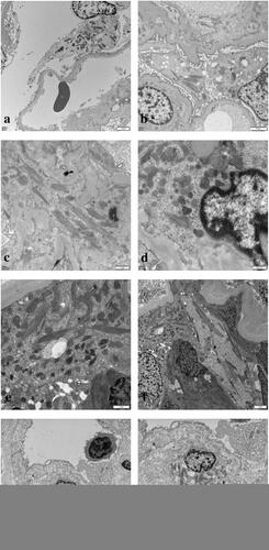 Figure 7. Electron microscopy showed crystalline inclusions in the podocytes (a, b), mesangial cells (c, d), proximal tubular epithelial cells (e, f), and histiocytes (g, h) (uranyl acetate and lead citrate staining, original magnification: a, f, g: ×4, 200, bar = 2 μm; b: ×6, 000, bar = 2 μm; c: ×9, 900, bar = 1 μm; d: ×20, 500, bar = 500 nm; e: ×11, 500, bar = 1 μm; h: ×6, 000, bar = 2 μm).