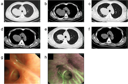 Figure 2. Radiological and bronchoscopic examination of the mass. (a,b) Computed tomography (CT) image of the mass at baseline; (c,d) CT image of the lesion after the 2nd cycle treatment; (e,f) CT image of the lesion after the 4th cycle treatment; (g) White light bronchoscopic image of obstruction by neoplasm in the apical segment of the right upper lobe; (h) Autofluorescence bronchoscopic image of obstruction by neoplasm in the apical segment of the right upper lobe.