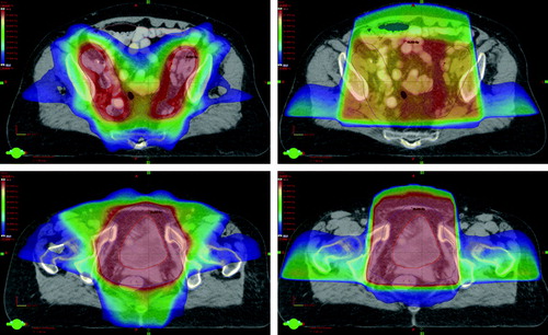 Figure 1.  Example of a treatment plan for RT of bladder cancer including the lymph nodes with IMRT (left) and the summed sequential CRT (right) in the upper (upper) and lower (lower) pelvis. Target volumes shown in red, intestine in pink, bladder in yellow and rectum in blue. Dose colour wash is from 25 Gy (dark blue) to 50 Gy (red).