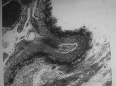 Figure 3. Thin granular electron dense deposition on subendothelial aspect of glomerular basal membrane. (Magnification × 40,000.)