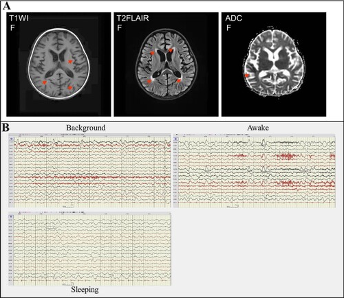 Figure 3. Brain imaging and EEG on day 28 of the illness. Panel A: MRI of the brain indicated abnormal signals on DWI, ADC, and T2-FLAIR images (marked with an arrow). DWI showed lamellar necrosis of the cerebral cortex; T2-FLAIR indicated cerebral sulci, bilateral lateral fissure cisterns, and lateral ventricle enlargement. Panel B: EEG presented the relative enhanced θ and δ activities with the continuous asymmetrical low waves manifested spike, sharp, or slow wave complex (black line marked).