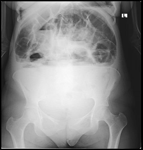Figure 1 Plain erect abdominal radiograph of the patient. Multiple central air fluid levels suggesting dilated small bowel loops. Whitening of the lower abdomen and pelvic space suggesting intraperitoneal significant fluid. Significantly dilated large bowel loop.