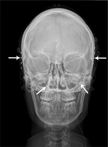 Figure 2 Postoperative X-ray demonstrates bilateral temporal and occipital stimulator leads. The four arrows point to the temporal and occipital leads.