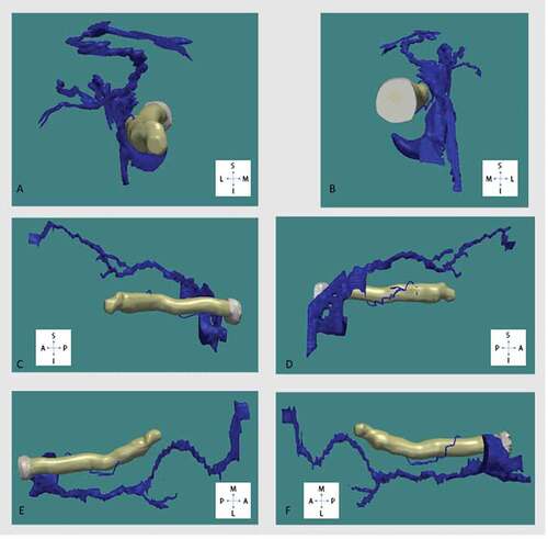 Figure 7. Three-D reconstruction the venous system in relation to the optic nerve viewed from (A) anterior, (B) posterior, (C) medial, (D) lateral, (E) superior, (F) inferior. Superior (S), inferior (I), anterior (A), posterior (P), medial (M), lateral (L)