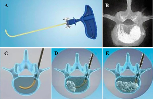 Figure 1 (A) Percutaneous Curved Vertebroplasty Device; (B) The bone cement distribution of PCVP is kidney-shaped and mainly located in the anterior and middle of the vertebral body; (C) insert curved injection cannula via straight trocar into the contralateral hemivertebra body; (D and E) The bone cement was injected with the cannula withdrawn point-by-point.