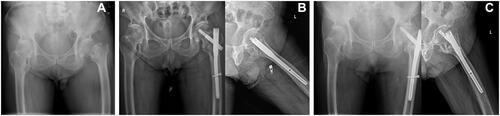 Figure 3 (A) Preoperative X-ray showing intertrochanteric fracture. (B) Postoperative X-ray showing reduction was acceptable. The lateral position showed the anterior cortex of the femur was obviously cortical encroachment. (C) The cut out of lag screw was found at one year of postoperative follow-up.