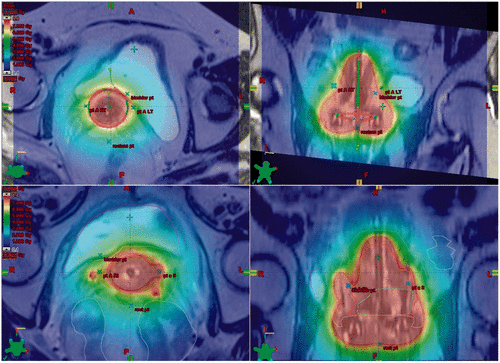 Figure 2. Axial and sagittal T2 weighted images from two different patients MRI planning scans. The top two images show the dose wash from a standard tandem ring applicator technique (red, high dose; blue, low dose). The bottom two images demonstrate how the addition of interstitial needles to the standard tandem ring applicator technique can help conform the dose around the IR-CTV (note how the interstitial needles on the right and left help extend the high dose coverage out towards the pelvic side walls).