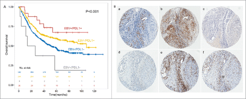 Figure 4. PDL1 expression associated with better outcome in the subgroup of EBV+ and EBV- GC patients (A). PDL1, PDL2, PD1, CD3 and CD8 expression in the identical EBV infected gastric cancer tissue (× 200, B). In situ hybridization of EBER (a) was shown in the identical patients together with PDL1 (b), PDL2 (c) and PD1 (d) expression in GC tumor tissues and CD3 (e) and CD8 (f) in intratumoral lymphocytes.