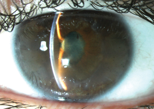Figure 1. Development of posterior synechiae, band keratopathy and cataract in undertreated JIA-U.