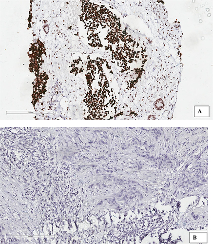 Figure 4 (A) Shows a tumor positive for WT1, and (B) Shows a tumor negative for WT1. All images were taken at x200.