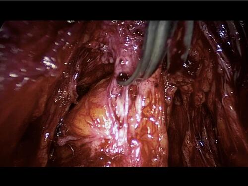 Figure 2 Shaving of a rectosigmoid nodule involving the uterosacral ligaments and retracting the bowel.