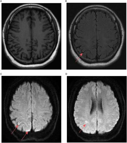 Figure 2. Brain MRI images of the patient (acquired 11-04-2018). (a) Isointensity on T1-weighted fluid-attenuated inversion recovery. (b) Right side of the parietal cortex, T2-weighted fluid-attenuated inversion recovery, slightly high signal. (c, d) Right side of the parietal cortex, diffusion-weighted imaging, high signal.
