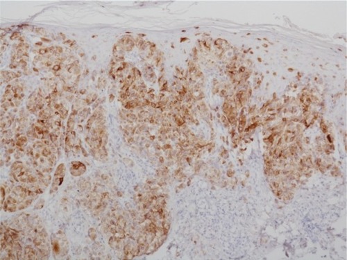 Figure 2 Immunohistochemistry using antibodies against melanocytic antigen (melan-A).Notes: The atypical melanocytes are stained with antibodies against melan-A; ×100.