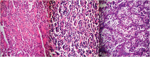 Figure 3. Photomicrographs of pituitary adenomas showing (a) acidophilic, (b) basophilic and (c) chromophobic adenomas [H&E stain x 400].