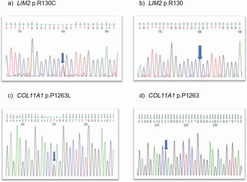 Figure 2. Sequence analysis—(a) LIM2–missense variant c.388c>t in affected member, (b) LIM2 wild type, (c) COL11A1-missense variant at c.3788c>t in affected and unaffected family members, and (d) wild-type COL11A1.