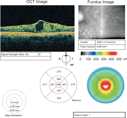 Figure 1 Central foveal thickness on presentation.