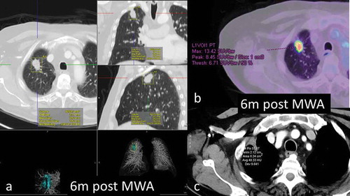 Figure 2. 68y-year-old male with biopsy proven RUL adenocarcinoma, 6-months assessment. a. volumetric assessment of ablated lesion – all three dimensions still significantly larger than pre- ablation b. FDG-PET scan shows very high SUVmax of 13.4 c. density of the ablated focus 48HU; marked pleural tagging present.